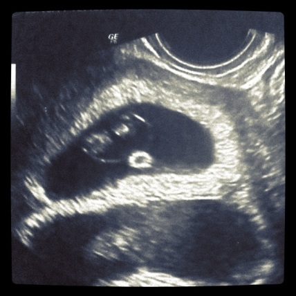 twins ultrasound 8 weeks